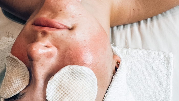 Client receiving a professional facial treatment representing our Valentine’s Day Advanced Aesthetics Skincare Special.